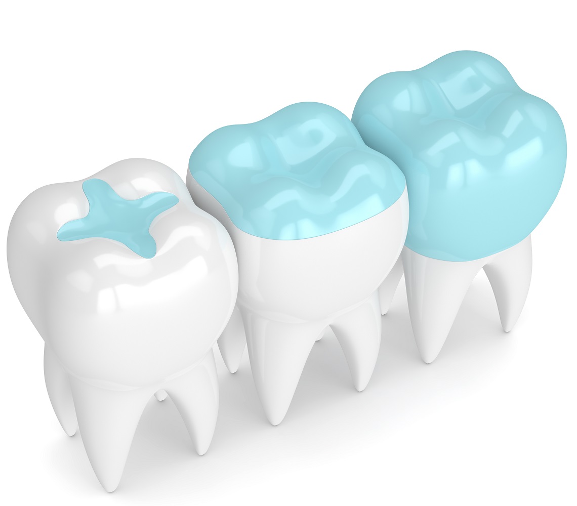 Dental Sealants Sugarland TX